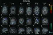 Perfusion weighted MRI patterns in neuropsychiatric systemic lupus erythematosus: a systematic review and meta-analysis