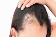 The effect of an oral product containing Amla fruit (Phyllanthus emblica L.) on female androgenetic alopecia: A randomized controlled trial