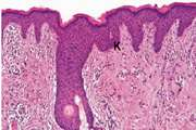 Efficacy and Tolerability of a Hyaluronic Acid-Based Extracellular Matrix for Labia Majora Rejuvenation and Augmentation: A Pilot Study