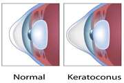 The microenvironment of ocular surface in keratoconus: a systematic review
