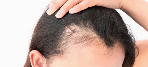 The effect of an oral product containing Amla fruit (Phyllanthus emblica L.) on female androgenetic alopecia: A randomized controlled trial
